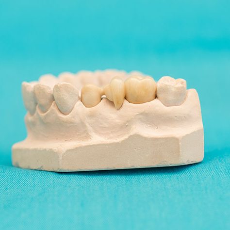 Zahnarzt in Bad Kreuznach - Zahnarztpraxis Kessler & Bruns - Detailfoto Vollkeramischer-Zahnersatz